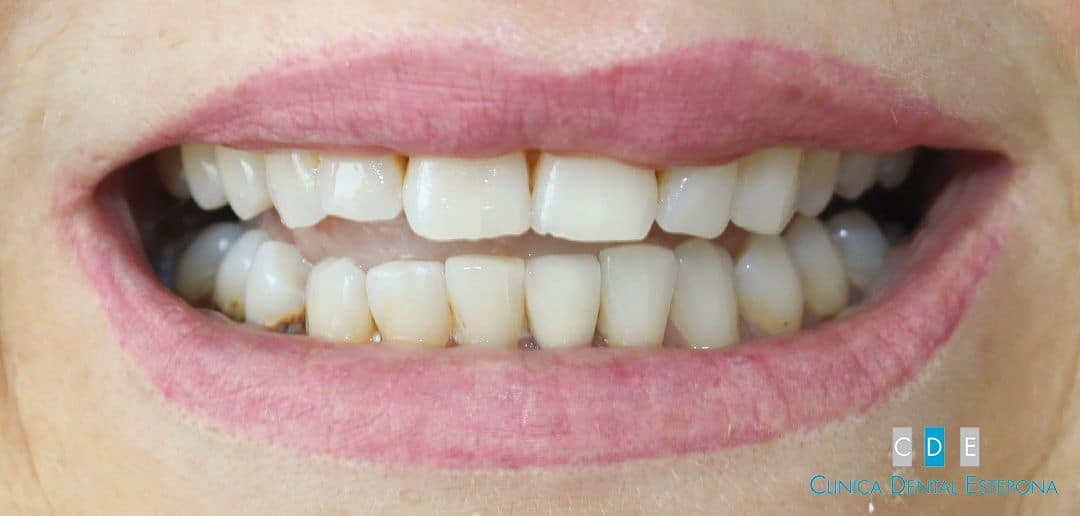 Porcelain Veneers — Before